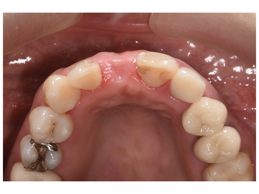 前歯部のインプラント治療（一次オペ）gbr、ctgを併用して行いました！