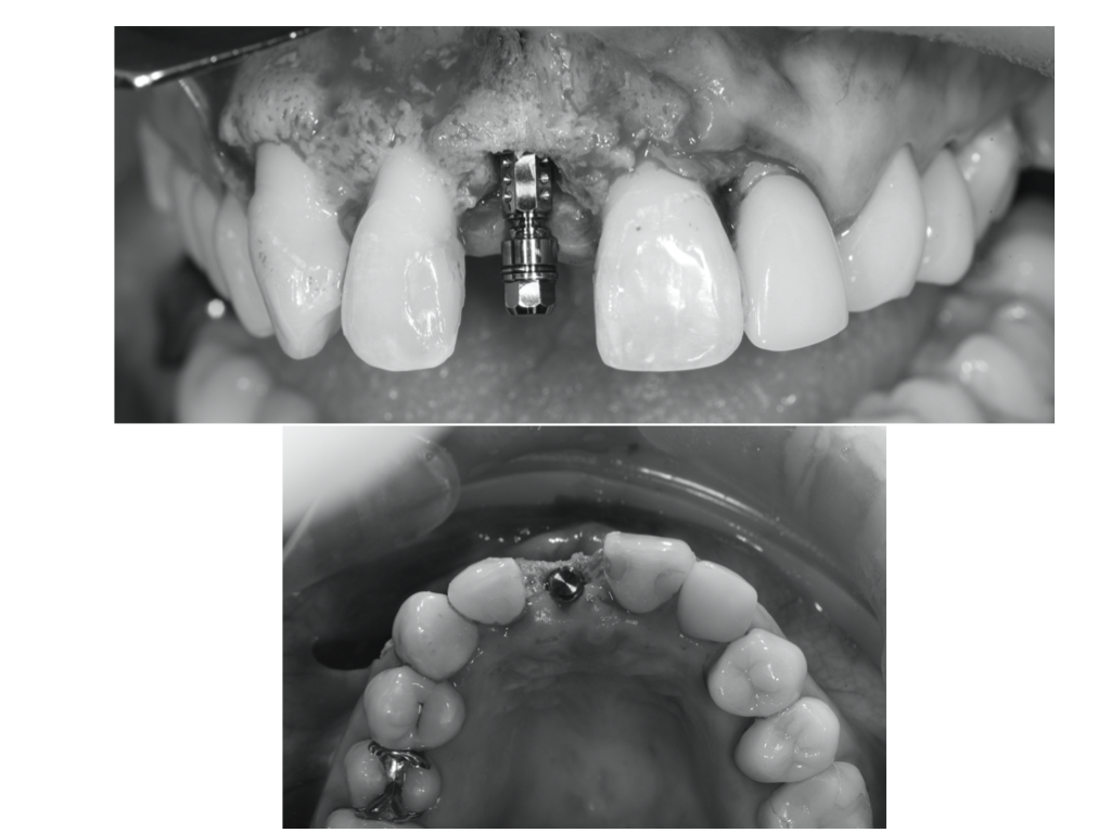前歯部のインプラント治療（一次オペ）gbr、ctgを併用して行いました！