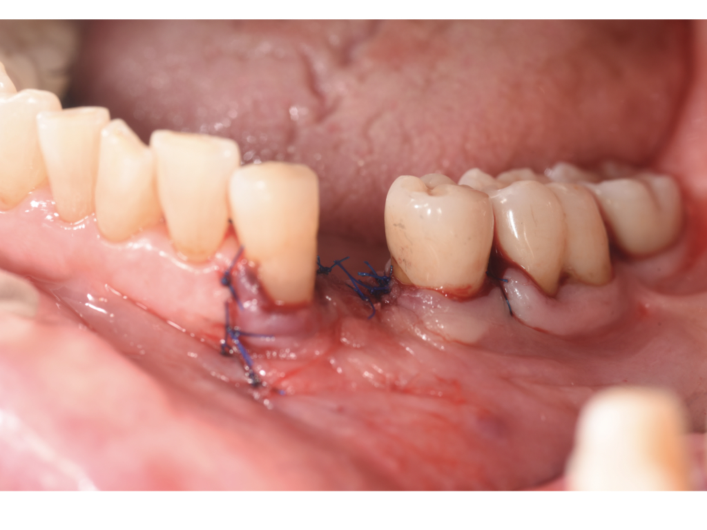 骨吸収し難易度が高くなってしまった小臼歯部のインプラント。