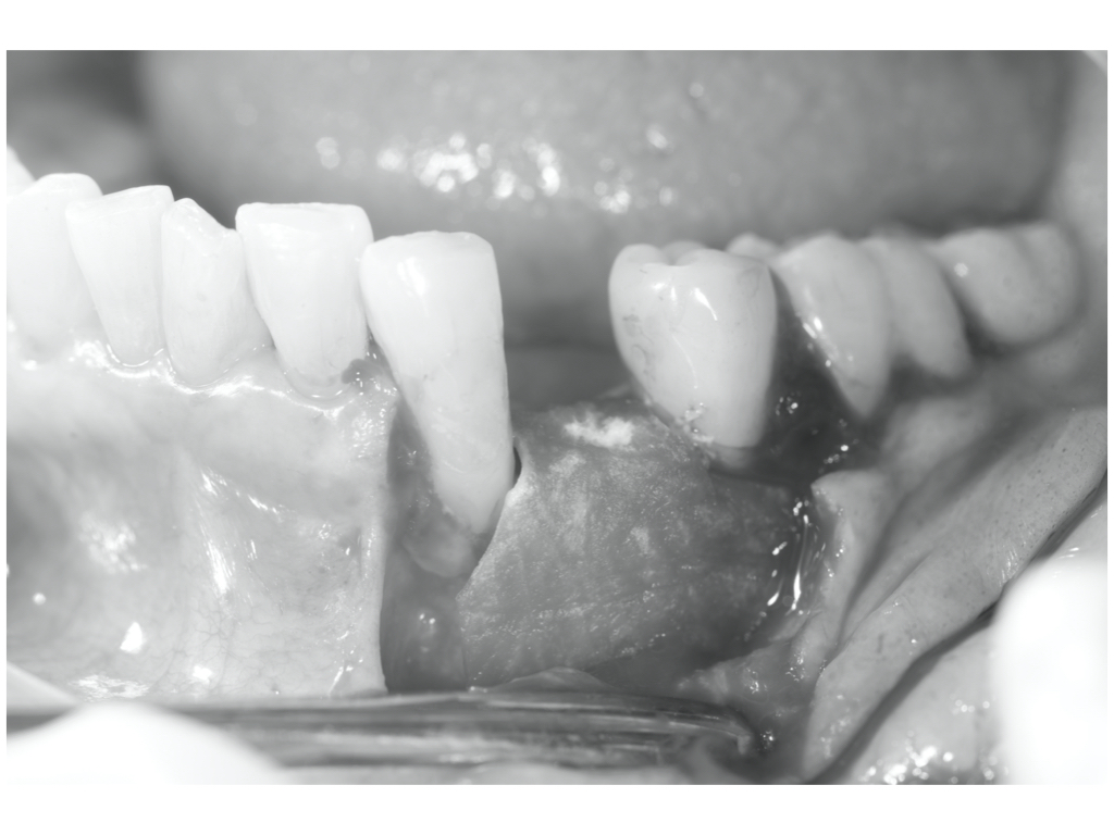 骨吸収し難易度が高くなってしまった小臼歯部のインプラント。