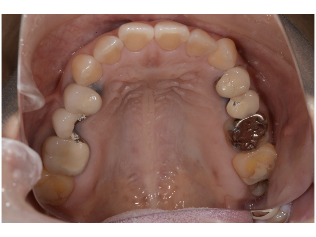 前歯の重要性！奥歯の運命は前歯が握っています。