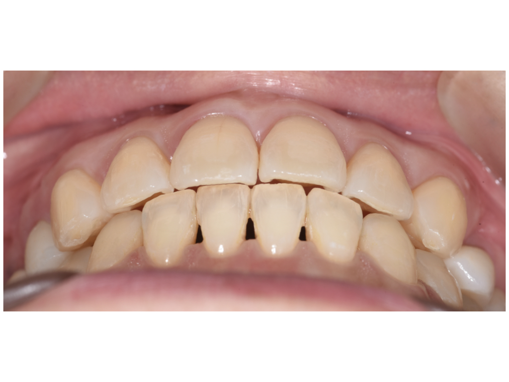 前歯の重要性！奥歯の運命は前歯が握っています。