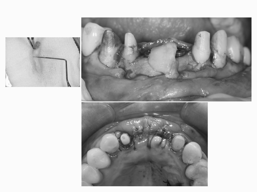 前歯部のインプラントで重要なGBR（骨造成）とCTG（結合組織移植）