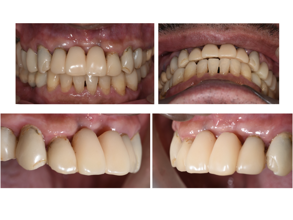 前歯部のインプラントで重要なGBR（骨造成）とCTG（結合組織移植）
