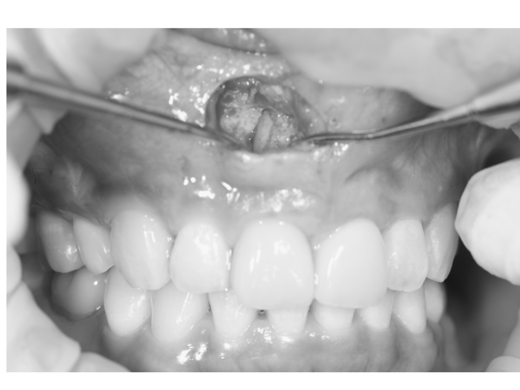 歯根破折からの低侵襲インプラント治療