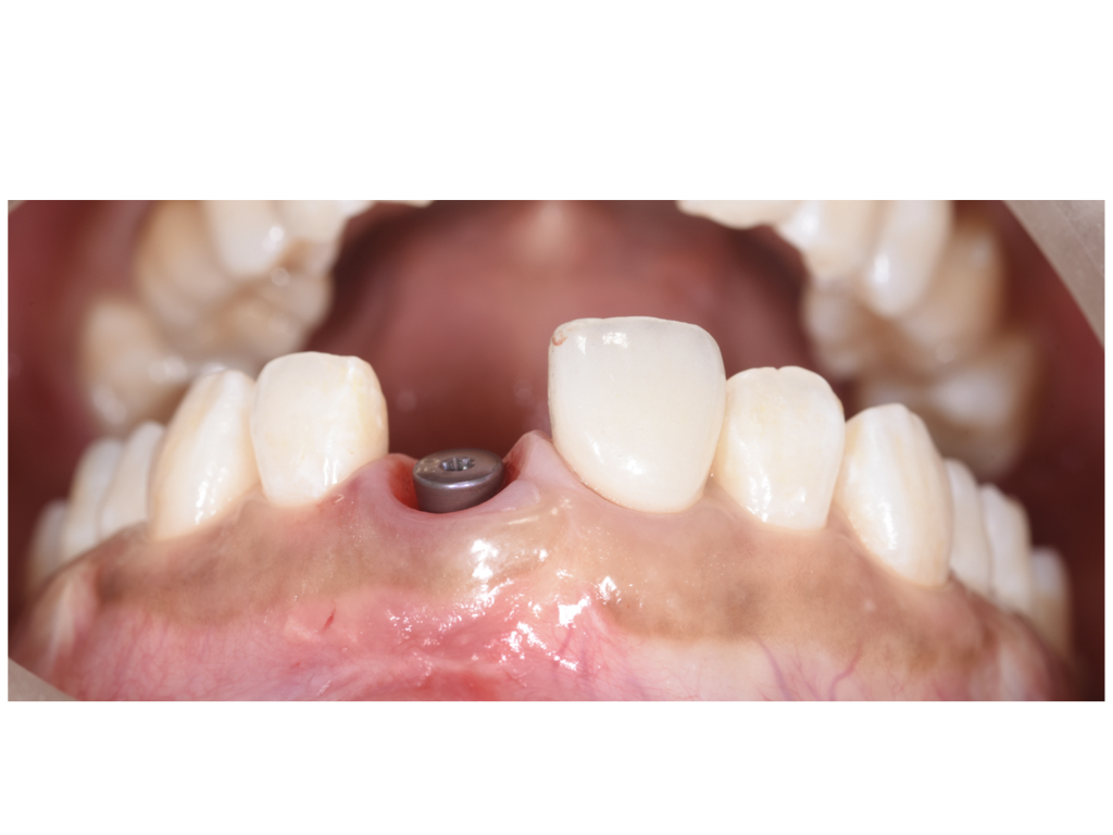 歯根破折からの低侵襲インプラント治療