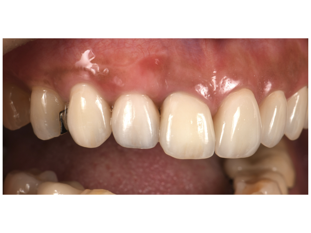 前歯のインプラント治療　審美的に仕上げる方法
