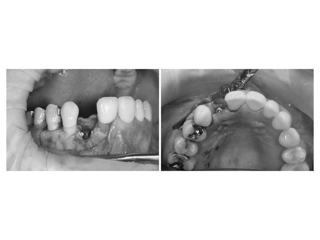 前歯のインプラント治療　審美的に仕上げる方法