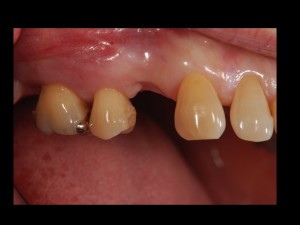インプラント手術は周りの歯の治療が重要です！