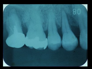 インプラント手術は周りの歯の治療が重要です！