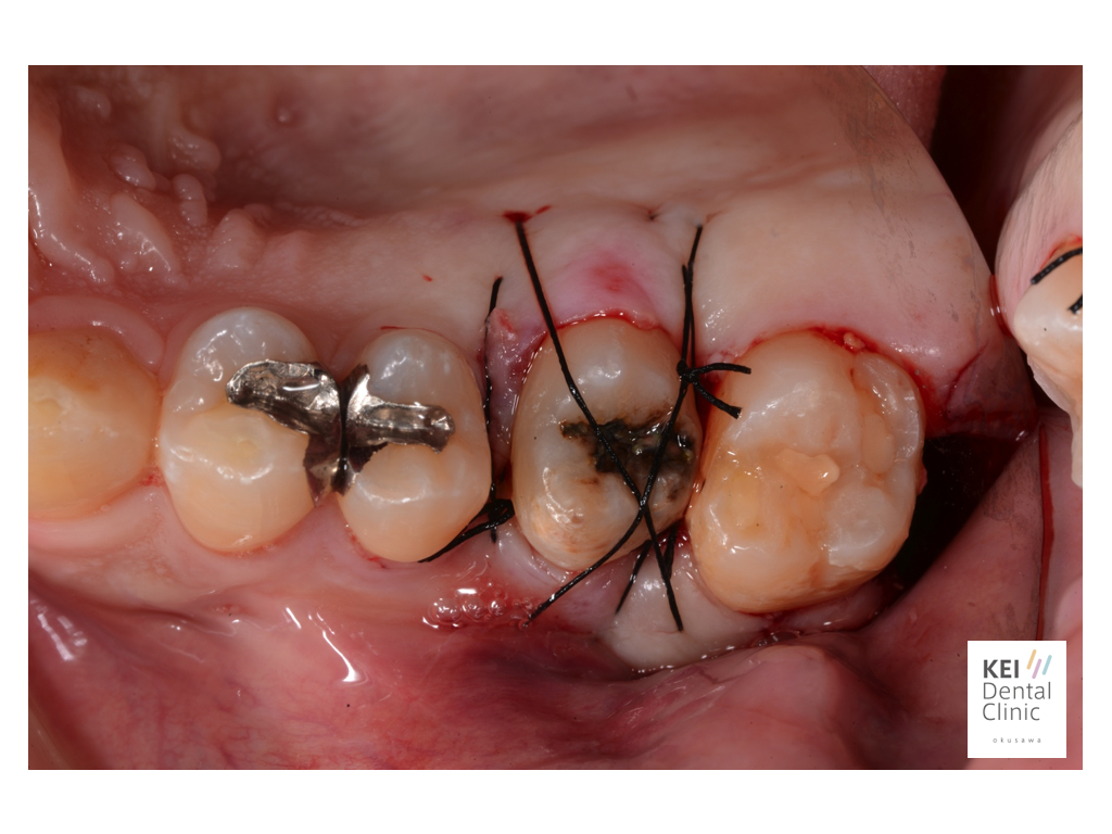 インプラント治療に代わる歯牙再植！