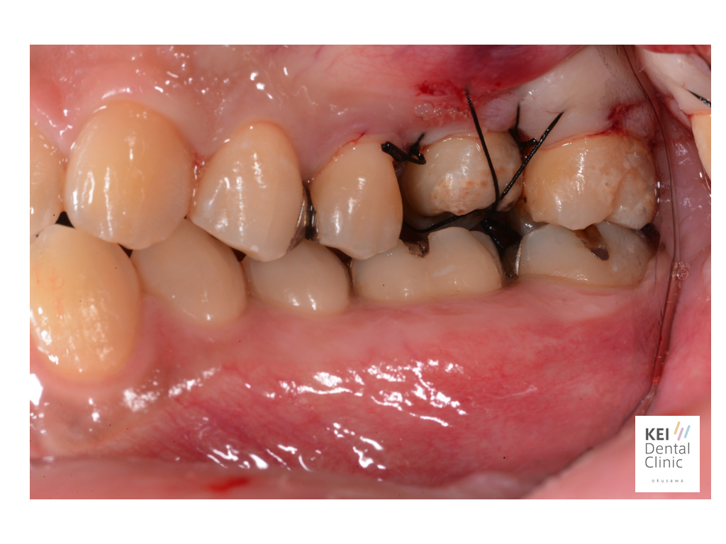 インプラント治療に代わる歯牙再植！