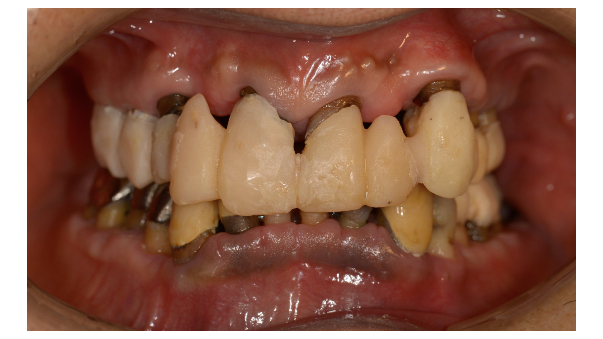 GBR（骨造成）CTG（結合組織移植）を併用した全顎的なインプラント治療