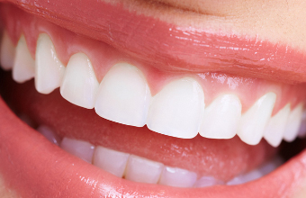 きれいな歯並びは虫歯や歯周病を防ぎます